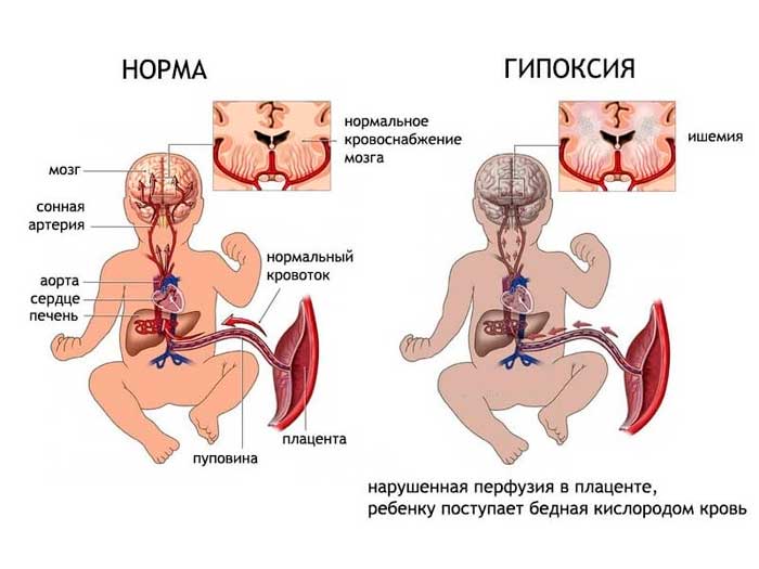 гипоксия