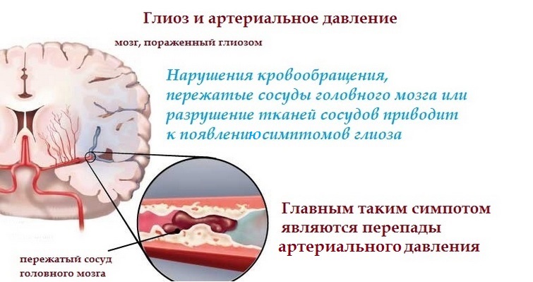 Причины глиоза головного мозга