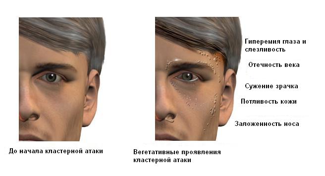 кластерная головная боль