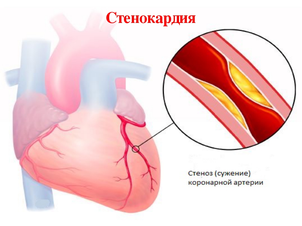 стенокардия