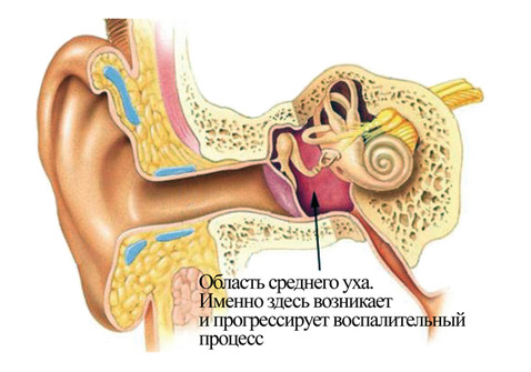 воспаления среднего уха