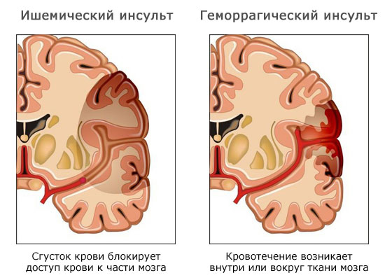 типы инсульта