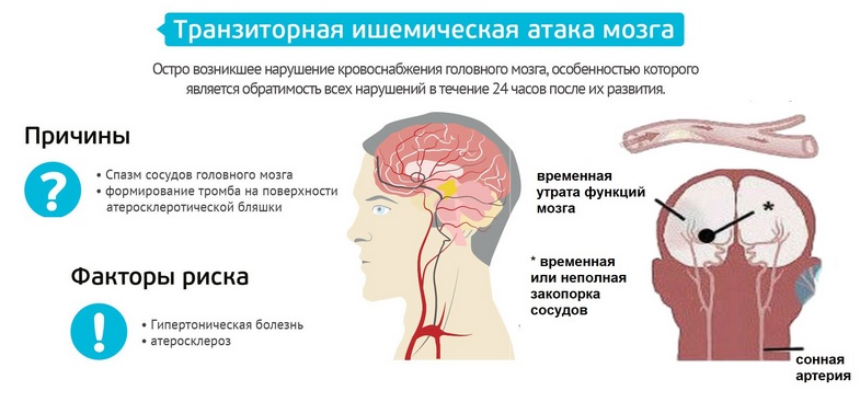транзиторная ишемическая атака