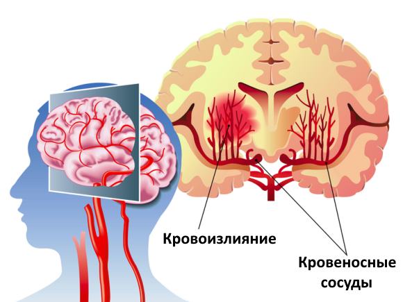 кровоизлияние в мозг