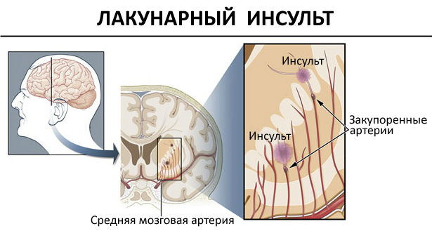 лакунарный инсульт симптомы первые признаки