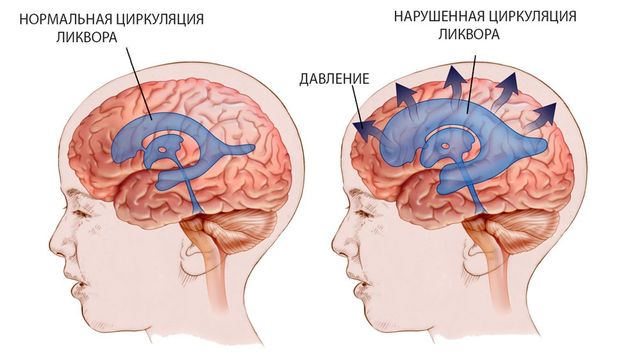 Симптомы ликворной