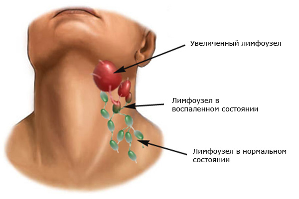 Осложнения, шегрена