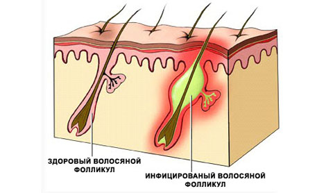 воспаления волосяного фолликула