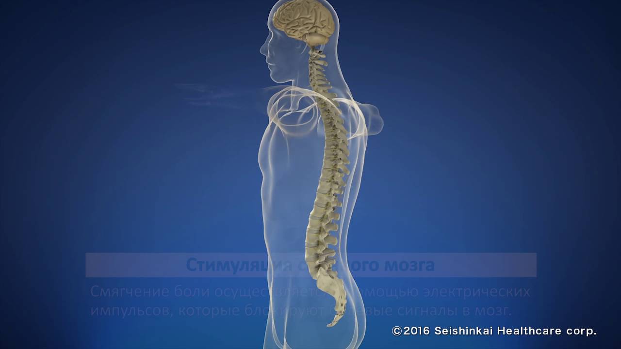 стимуляция Осложнения спинного воздействие мозга