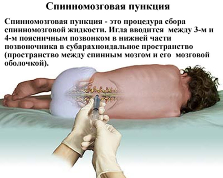анализ спинномозговой жидкости