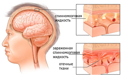 мозг человека зараженный менингитом