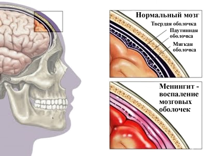Менингит