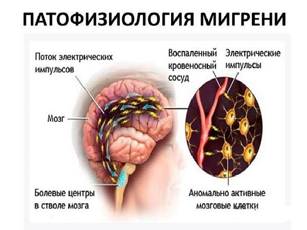 патофизиология мигрени