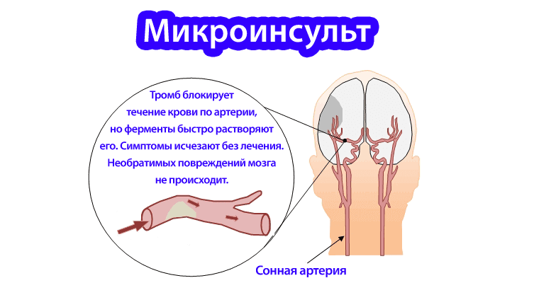 микроинсульт
