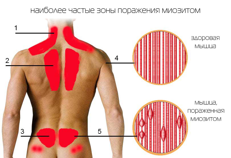 миозит