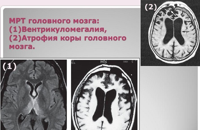 Вентрикуломегалия