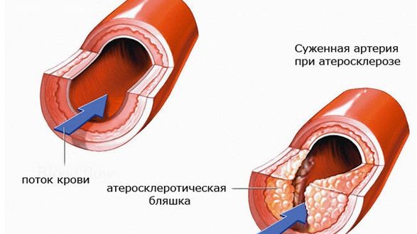 Cужению артерий