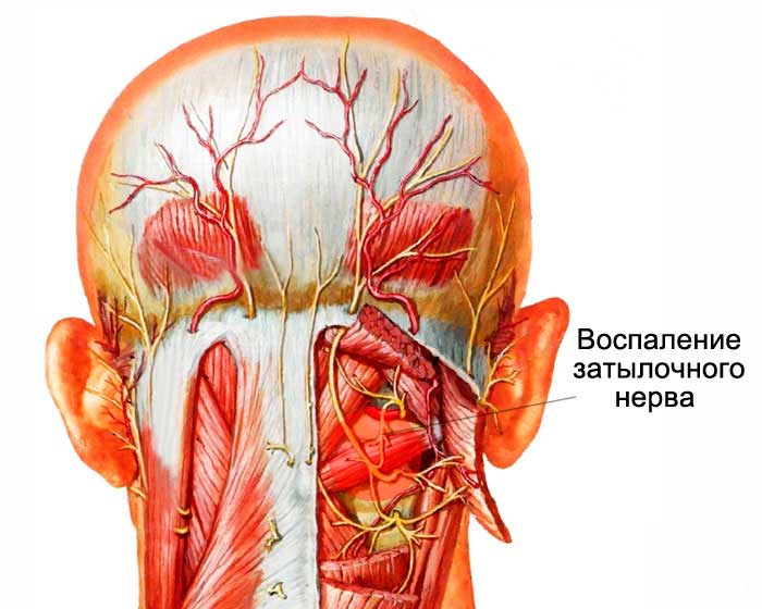 Невралгия затылочного нерва