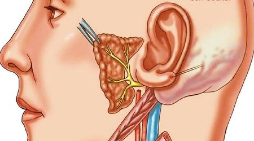 уха Виды неврита