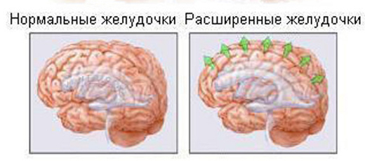 расширенные желудочки головного мозга