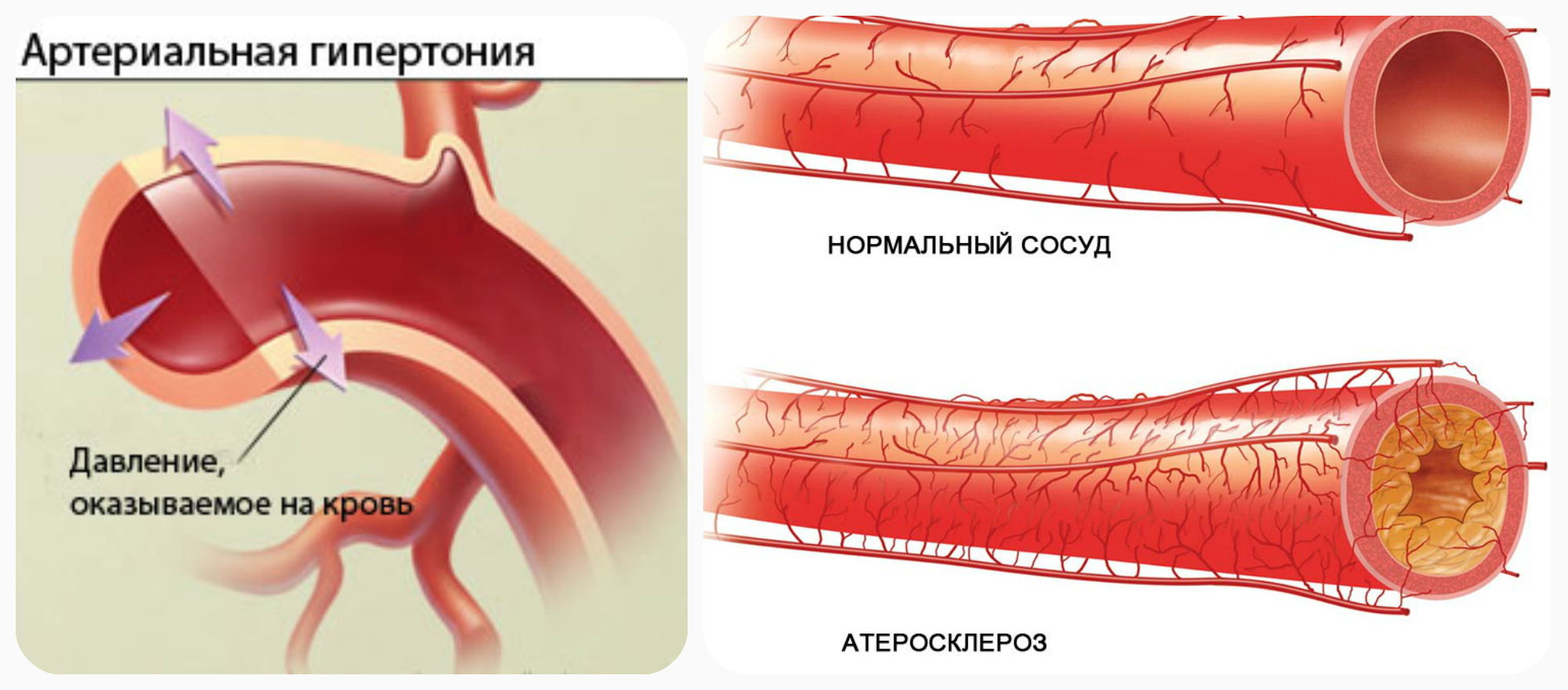 гипертония и атеросклероз