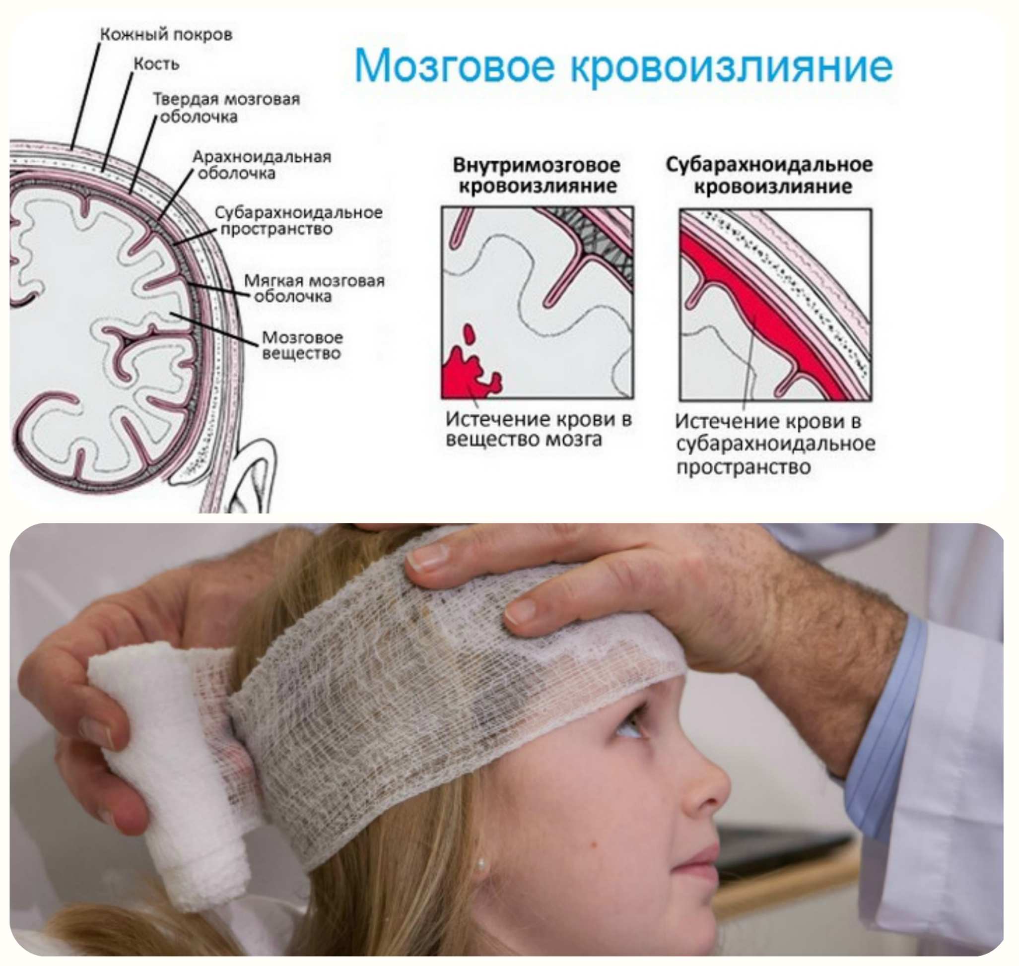 мозговое кровоизлияние, травма головы