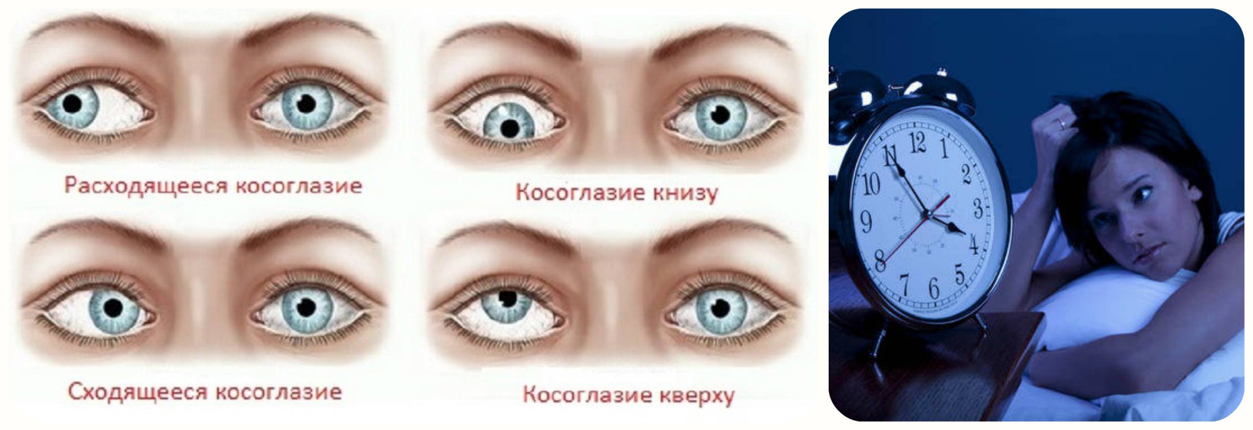 косоглазие, бессонница