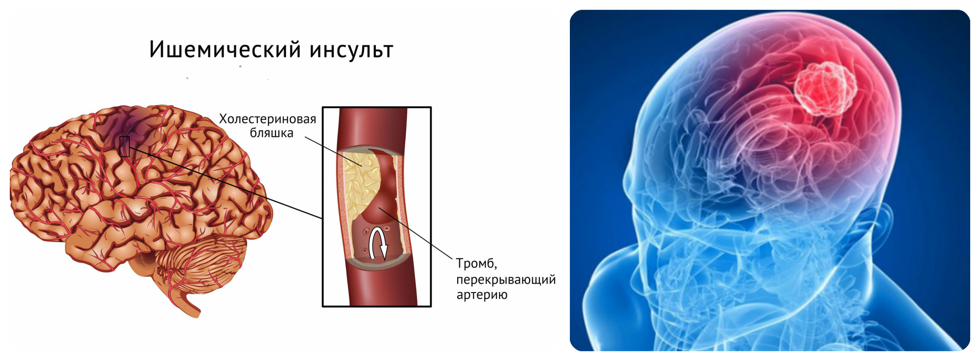 опухоль ишемический инсульт
