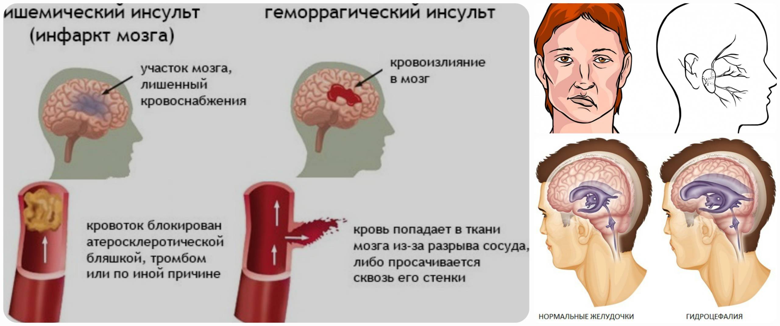 Инсульт гидроэнцефалия