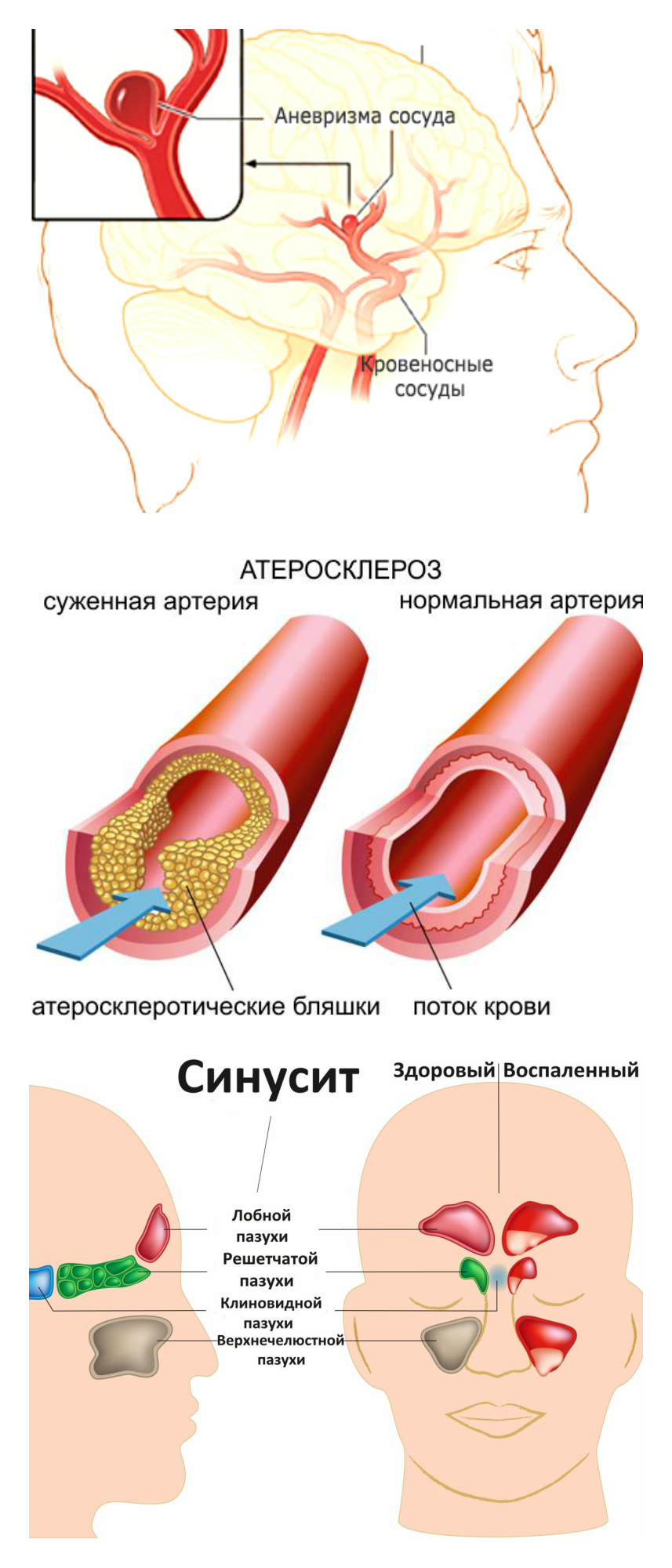 аневризма, атеросклероз, синусит