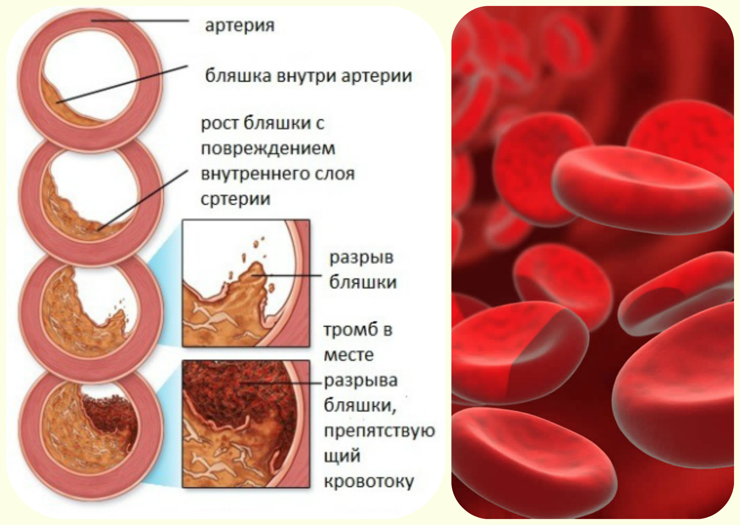 гипоксия мозга - схема развития