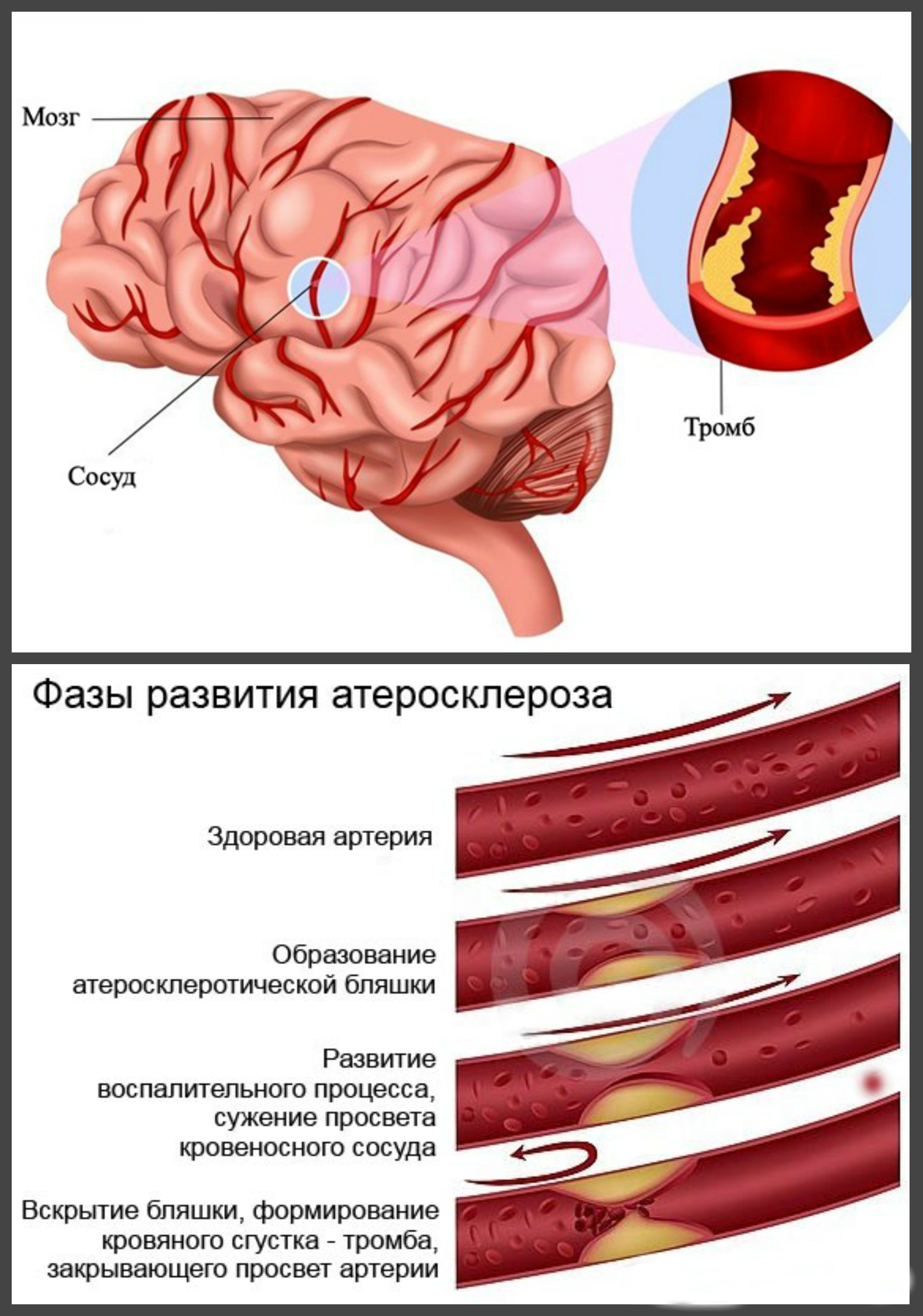 тромб, атеросклероз