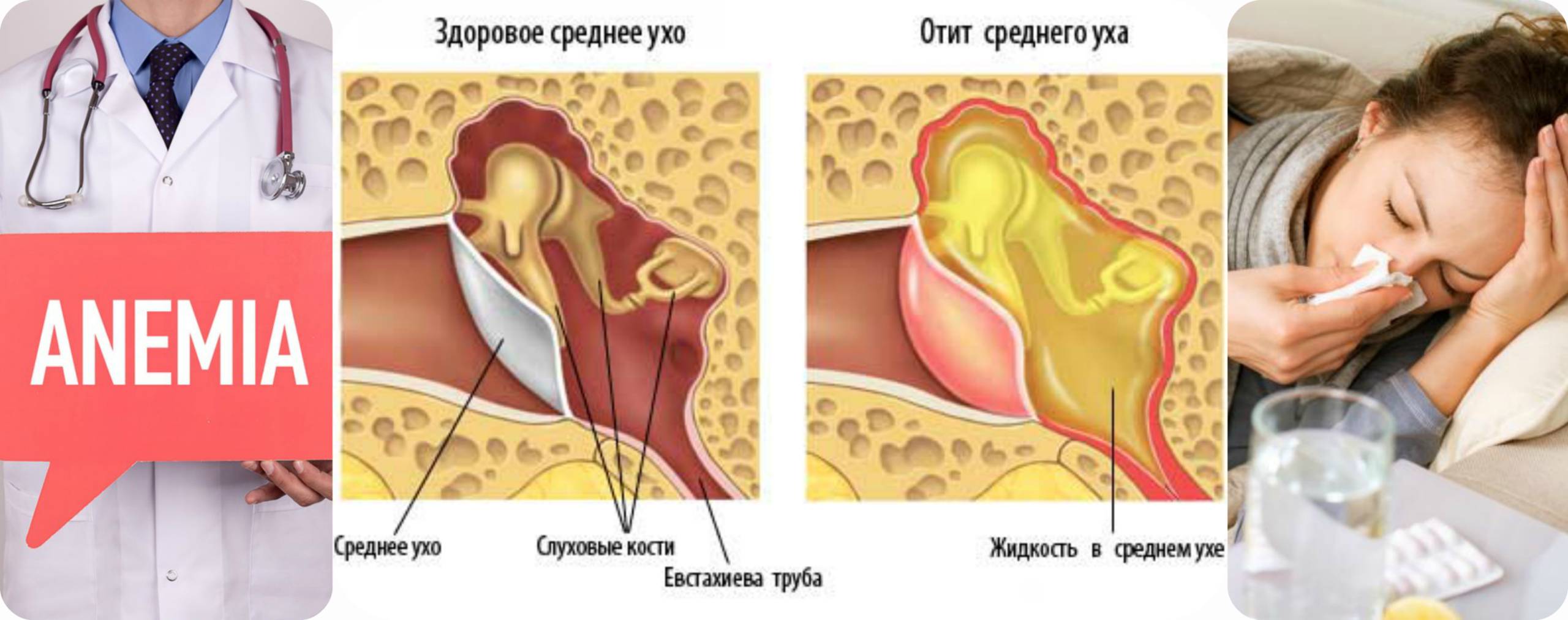 отит, анемия , грипп