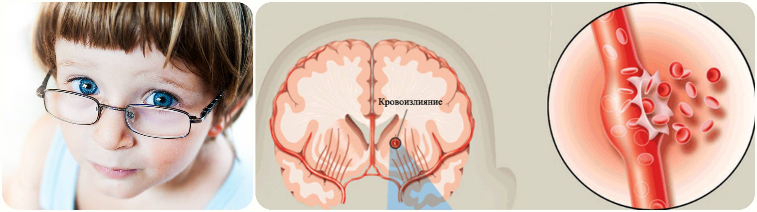 мальчик в очках, кровоизлияние в мозг
