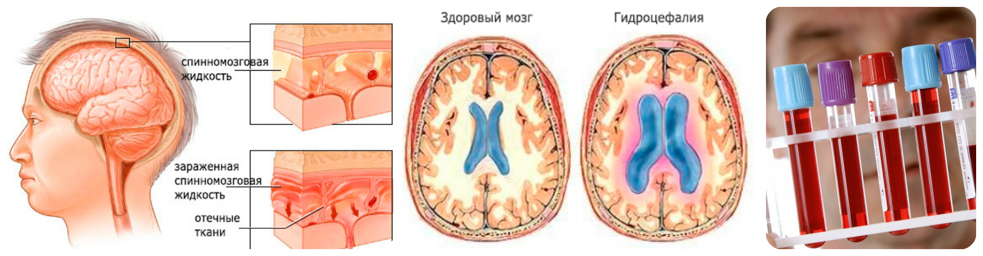 гидроэцофалия, воспаление оболочки мозга, биохимеческий дисбаланс
