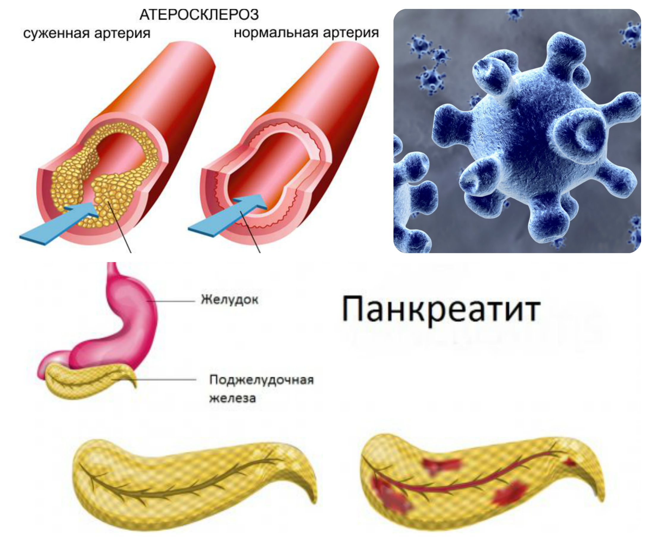 Панкреатит атеросклероз инфекции