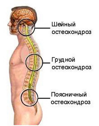 остеохондроз