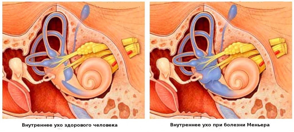 болезнь Меньера