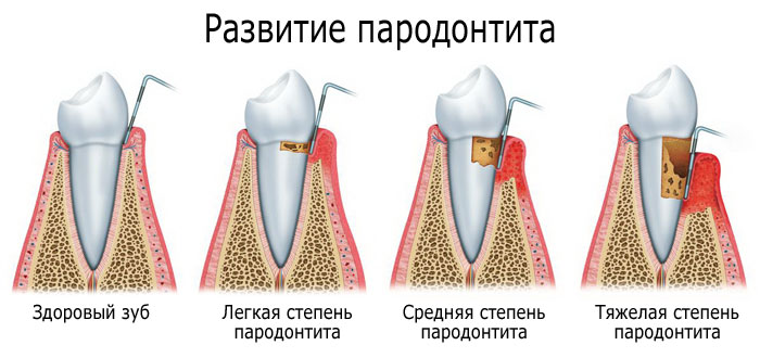 пародонтит