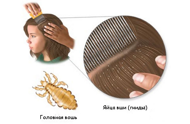 вошь и яйца вшей