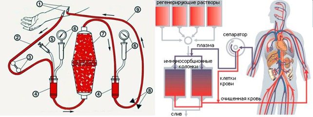 Плазмаферез