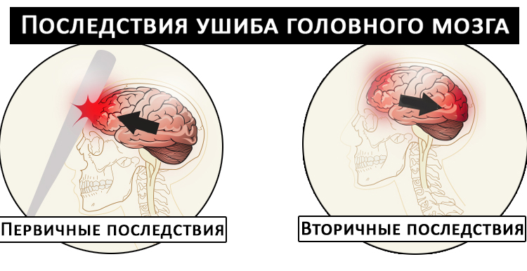 Ушиб головного мозга