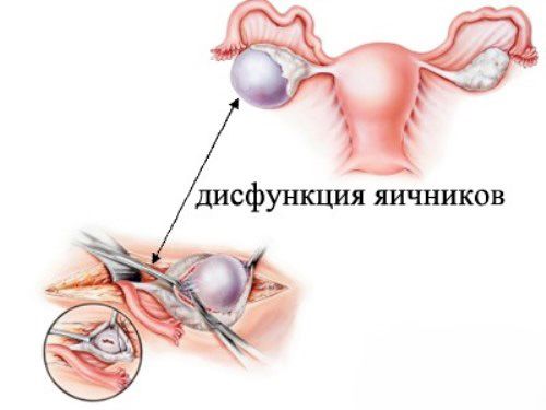 дисфункция яичников