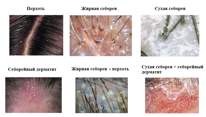 перхоть и себорея