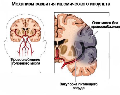 механизразвития ишемического инсульта