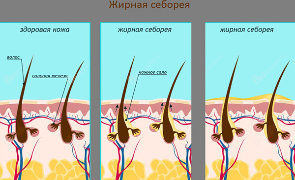 Лечение себореи кожи головы: чем опасно заболевание?