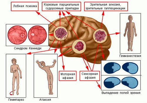 рак мозга его признаки