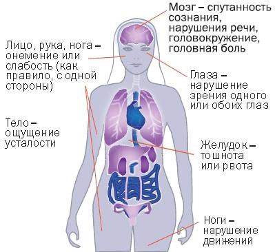 симптомы нарушений мозгового кровообращения