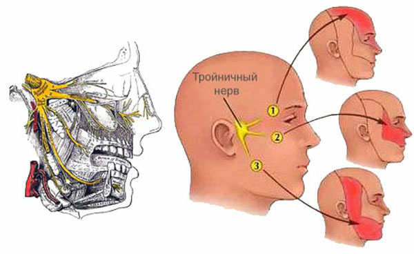 Невралгическая цефалгия