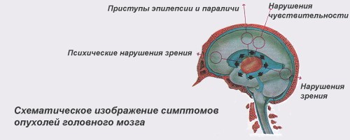 Схема: опухоль головного мозга симптомы